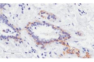 Immunohistochemical staining of paraffin embedded human breast tissue using anti-erbB-2 antibody. (Recombinant ErbB2/Her2 (Trastuzumab Biosimilar) 抗体)