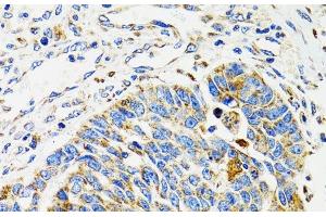 Immunohistochemistry of paraffin-embedded Human esophageal cancer using SH2B1 Polyclonal Antibody at dilution of 1:100 (40x lens). (SH2B1 抗体)