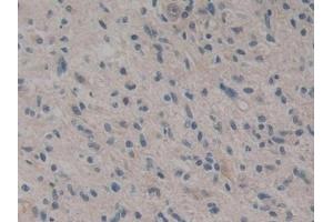 Detection of CARD9 in Human Glioma Tissue using Polyclonal Antibody to Caspase Recruitment Domain Family, Member 9 (CARD9)