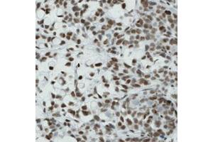 Immunohistochemical staining (Formalin-fixed paraffin-embedded sections) of human stomach cancer with CTCF monoclonal antibody, clone CL0307  shows nuclear immunoreactivity in tumor cells. (CTCF 抗体)