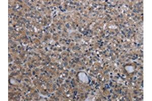 The image on the left is immunohistochemistry of paraffin-embedded Human thyroid cancer tissue using ABIN7130197(MCM3AP Antibody) at dilution 1/30, on the right is treated with fusion protein. (GANP 抗体)