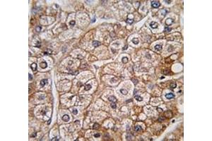 IHC analysis of FFPE human hepatocarcinoma tissue stained with BMPR2 antibody (BMPR2 抗体  (AA 27-56))