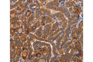 Immunohistochemistry of Human colon cancer using BMP6 Polyclonal Antibody at dilution of 1:40 (BMP6 抗体)