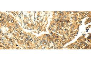 Immunohistochemistry of paraffin-embedded Human lung cancer tissue using SERPINA12 Polyclonal Antibody at dilution 1:40 (SERPINA12 抗体)