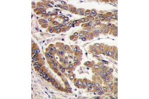 Formalin-fixed and paraffin-embedded human lung carcinoma tissue reacted with PKC zeta antibody (N-term), which was peroxidase-conjugated to the secondary antibody, followed by DAB staining.