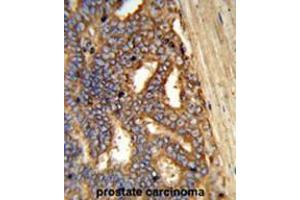 Formalin-fixed and paraffin-embedded human prostate carcinoma reacted with AMY1A Antibody (Center), which was peroxidase-conjugated to the secondary antibody, followed by DAB staining. (Alpha-amylase 1 抗体  (Middle Region))