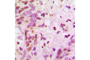 Immunohistochemical analysis of hnRNP A2/B1 staining in human breast cancer formalin fixed paraffin embedded tissue section. (HNRNPA2B1 抗体  (N-Term))