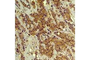 Immunohistochemical analysis of ERK1/2 staining in human breast cancer formalin fixed paraffin embedded tissue section. (ERK1/2 抗体)