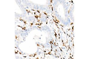Immunohistochemistry of paraffin-embedded Human colon carcinoma using CD74 antibody (ABIN7267759) at dilution of 1:100 (40x lens). (CD74 抗体)