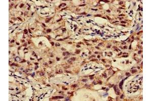 Immunohistochemistry of paraffin-embedded human lung cancer using ABIN7144675 at dilution of 1:100 (NAT1 抗体  (AA 1-288))