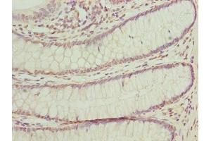 Immunohistochemistry of paraffin-embedded human colon cancer using ABIN7165150 at dilution of 1:100 (BUD31 抗体  (AA 1-144))