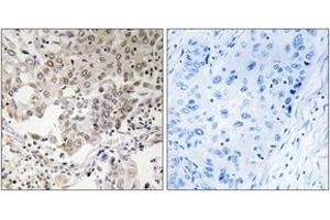 Immunohistochemistry analysis of paraffin-embedded human lung carcinoma, using NCAPG2 Antibody.