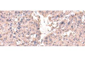 Immunohistochemistry of paraffin-embedded Human liver cancer tissue using HPN Polyclonal Antibody at dilution of 1:50(x200) (Hepsin 抗体)
