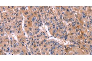Immunohistochemistry of paraffin-embedded Human liver cancer using CD269 Polyclonal Antibody at dilution of 1:30 (BCMA 抗体)