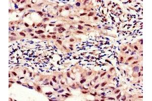 Immunohistochemistry of paraffin-embedded human lung cancer using ABIN7142693 at dilution of 1:100 (PFKFB2 抗体  (AA 360-505))