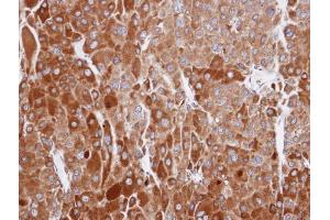 IHC-P Image Immunohistochemical analysis of paraffin-embedded human adrenal cortical tumor, using RIC8A, antibody at 1:100 dilution. (RIC8A 抗体  (C-Term))