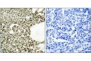 Immunohistochemistry analysis of paraffin-embedded human breast carcinoma, using STAT1 (Phospho-Ser727) Antibody. (STAT1 抗体  (pSer727))