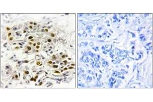 Immunohistochemistry analysis of paraffin-embedded human breast carcinoma tissue, using MAP3K6 Antibody. (MAP3K6 抗体  (AA 281-330))