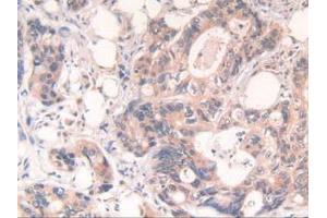 IHC-P analysis of Human Rectum Cancer Tissue, with DAB staining. (POR 抗体  (AA 77-518))