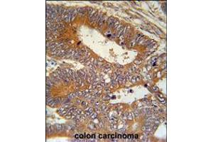 MAP1S Antibody immunohistochemistry analysis in formalin fixed and paraffin embedded human colon carcinoma followed by peroxidase conjugation of the secondary antibody and DAB staining.