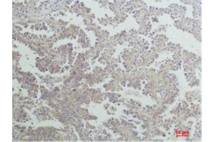 Immunohistochemistry (IHC) analysis of paraffin-embedded Human Lung Carcinoma using Nrf2 Rabbit Polyclonal Antibody diluted at 1:200. (NRF2 抗体)