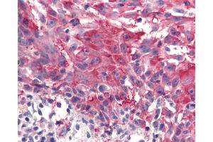 Anti-FZD4 / Frizzled 4 antibody IHC of human Skin, Melanoma. (FZD4 抗体  (C-Term))