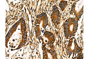 ABIN6258609 and ABIN6274191 at 1/100 staining Human colorectal cancer by IHC-P. (Hexokinase 1 抗体  (N-Term))