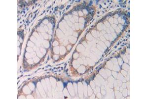 IHC-P analysis of rectum cancer tissue, with DAB staining. (IL1R1 抗体  (AA 226-318))