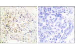 Immunohistochemistry analysis of paraffin-embedded human breast carcinoma tissue, using HER3 Antibody. (ERBB3 抗体  (AA 1-50))