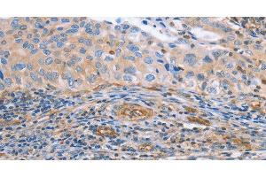 Immunohistochemistry of paraffin-embedded Human cervical cancer tissue using NRG4 Polyclonal Antibody at dilution 1:60 (Neuregulin 4 抗体)