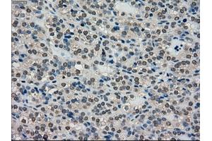 Immunohistochemical staining of paraffin-embedded Adenocarcinoma of breast tissue using anti-SCYL3 mouse monoclonal antibody. (SCYL3 抗体)