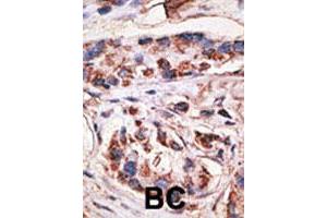 Formalin-fixed and paraffin-embedded human breast cancer tissue reacted with MAGEA1 polyclonal antibody  , which was peroxidase-conjugated to the secondary antibody, followed by DAB staining. (MAGEA1 抗体  (Internal Region))