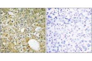 Immunohistochemistry analysis of paraffin-embedded human breast carcinoma tissue, using ACVL1 Antibody. (ACVRL1 抗体  (AA 196-245))