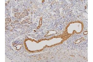 IHC analysis of RAB3GAP2 using anti-RAB3GAP2 antibody (ABIN6719633). (RAB3GAP2 抗体  (AA 1-115))