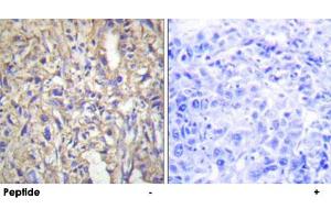 Immunohistochemistry analysis of paraffin-embedded human liver carcinoma tissue using LAMB1 polyclonal antibody . (Laminin beta 1 抗体  (C-Term))
