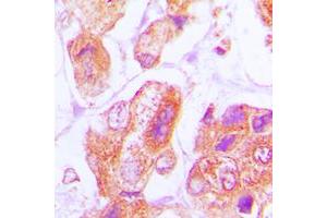 Immunohistochemical analysis of DNAJB11 staining in human lung cancer formalin fixed paraffin embedded tissue section. (DNAJB11 抗体  (Center))