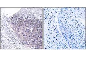 Immunohistochemistry analysis of paraffin-embedded human cervix carcinoma tissue, using GTPBP5 Antibody. (GTPBP5 抗体  (AA 71-120))