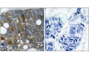 Immunohistochemistry analysis of paraffin-embedded human breast carcinoma, using HSP27 (Phospho-Ser15) Antibody. (HSP27 抗体  (pSer15))