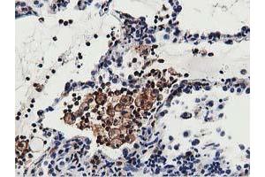 Immunohistochemical staining of paraffin-embedded Carcinoma of Human lung tissue using anti-MICAL1 mouse monoclonal antibody. (MICAL1 抗体)