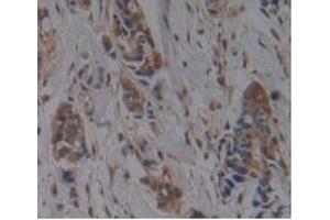 IHC-P analysis of Human Breast Cancer Tissue, with DAB staining. (HFE2 抗体  (AA 29-401))