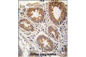 Formalin-fixed and paraffin-embedded human hepatocarcinoma tissue reacted with AHCY antibody (N-term) (ABIN389201 and ABIN2839361) , which was peroxidase-conjugated to the secondary antibody, followed by DAB staining. (AHCY 抗体  (N-Term))