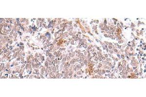 Immunohistochemistry of paraffin-embedded Human lung cancer tissue using INPP5K Polyclonal Antibody at dilution of 1:90(x200) (INPP5K 抗体)