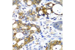 Immunohistochemistry of paraffin-embedded human gastric cancer using AMY2A antibody. (AMY2A 抗体)
