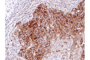 IHC-P Image Immunohistochemical analysis of paraffin-embedded SW480 xenograft, using RASGRP4 , antibody at 1:100 dilution. (RASGRP4 抗体  (N-Term))