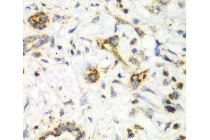 Immunohistochemistry of paraffin-embedded Human liver cancer using NRBF2 Polyclonal Antibody at dilution of 1:100 (40x lens). (NRBF2 抗体)