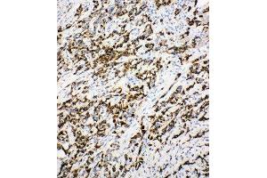 Anti-DCI antibody, IHC(P) IHC(P): Human Mammary Cancer Tissue (DCI 抗体  (C-Term))