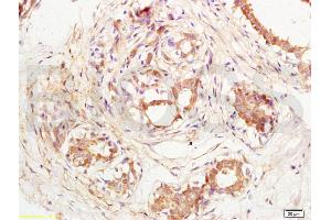 Formalin-fixed and paraffin embedded human breast carcinoma labeled with Anti-CD144/VECD/VE Cadherin Polyclonal Antibody, Unconjugated (ABIN729343) at 1:200, followed by conjugation to the secondary antibody and DAB staining (Cadherin 5 抗体  (AA 601-700))