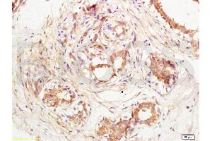 Formalin-fixed and paraffin embedded human breast carcinoma labeled with Anti-CD144/VECD/VE Cadherin Polyclonal Antibody, Unconjugated (ABIN729343) at 1:200, followed by conjugation to the secondary antibody and DAB staining