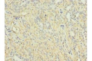 Immunohistochemistry of paraffin-embedded human breast cancer using ABIN7163997 at dilution of 1:100 (KCNH7 抗体  (AA 1-300))