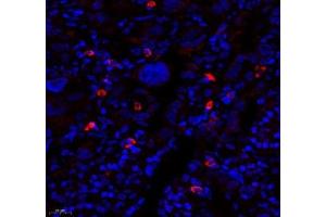 Immunofluorescence of paraffin embedded human lung cancer using MTND5 (ABIN7074659) at dilution of 1: 400 (450x lens) (MT-ND5 抗体)